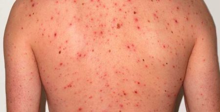 Alerta epidemiológica por sarampión en México, Chihuahua con más casos